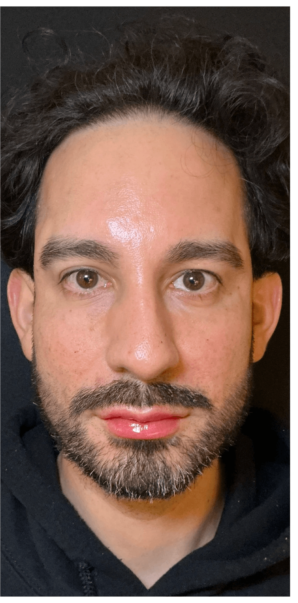 Armonía facial — Después