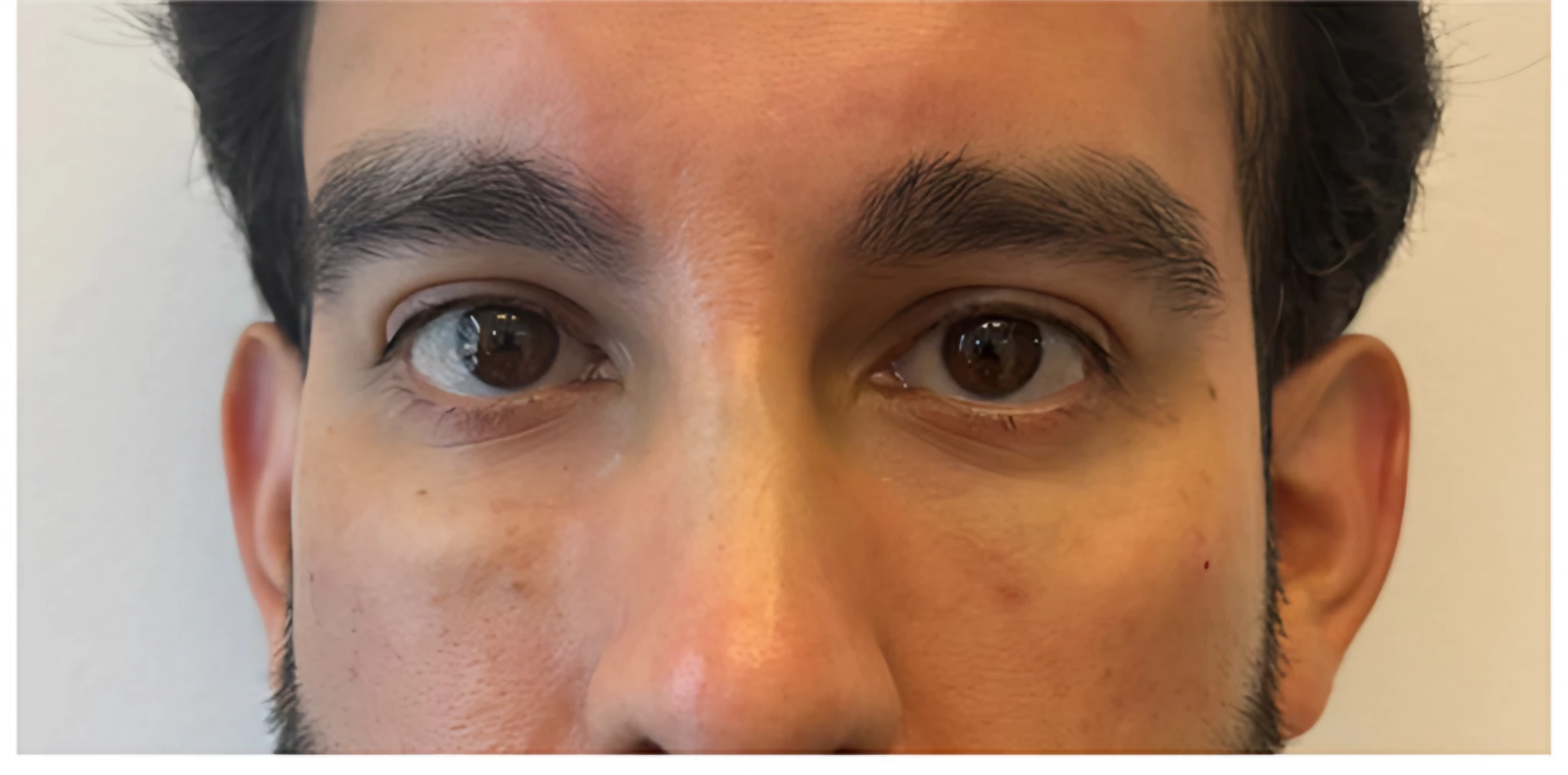 Golden Eye (PRF + EZ Gel) — Después