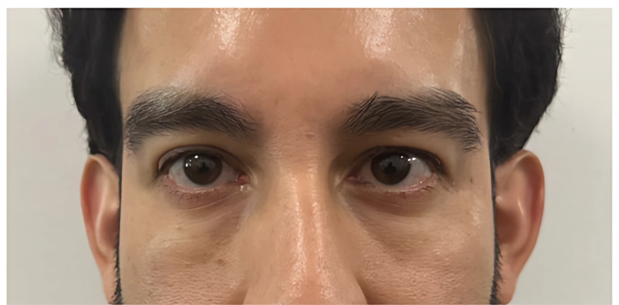 Golden Eye (PRF + EZ Gel) — Antes