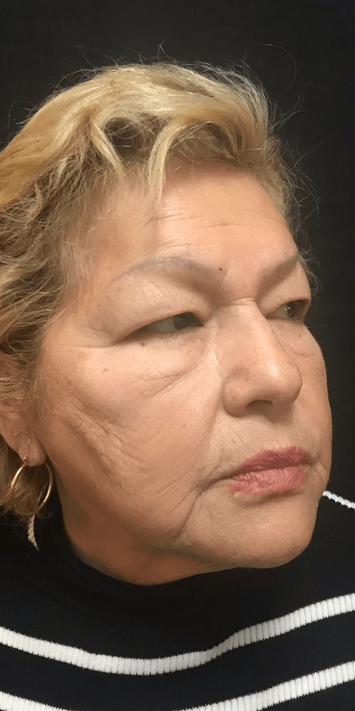 Rejuvenecimiento de la piel — Antes