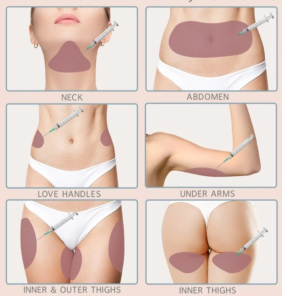 Diagrama de zonas para inyecciones que disuelven grasa: cuello, abdomen, flancos, axilas y muslos
