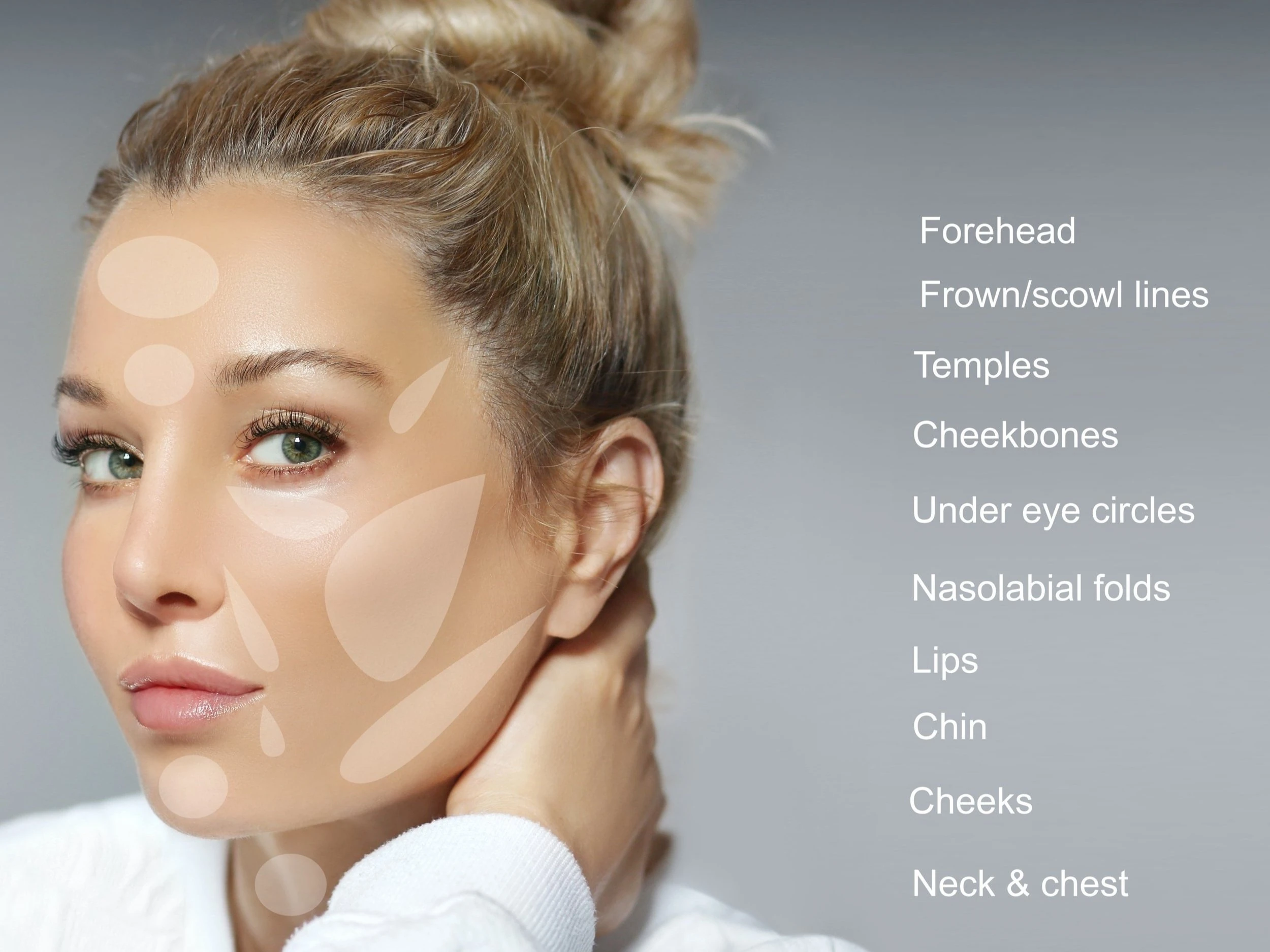 Diagrama de zonas de relleno en el rostro de una mujer: frente, entrecejo, sienes, pómulos, ojeras, surcos nasolabiales, labios, mentón, mejillas, y cuello y pecho