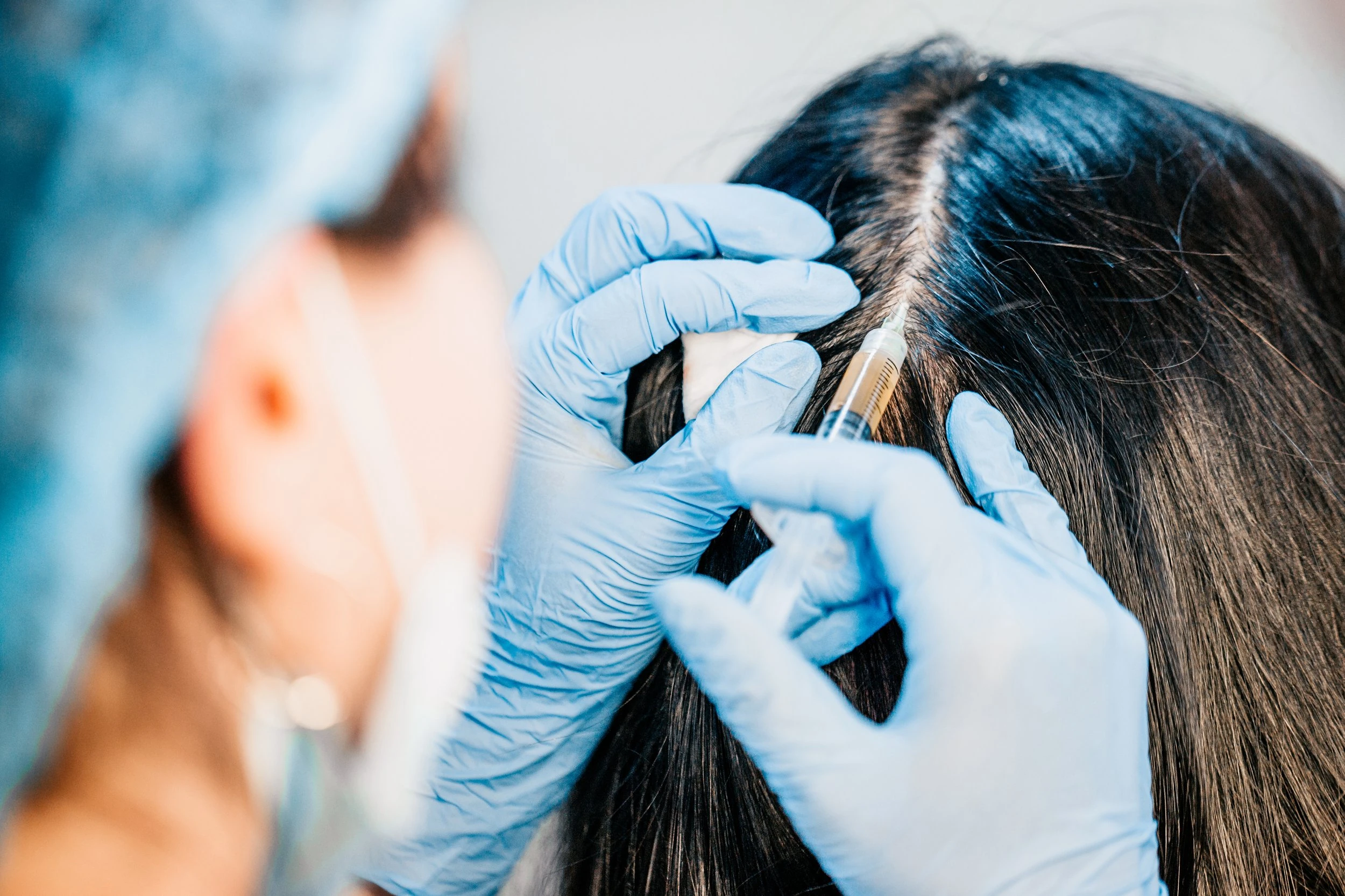 Manos con guantes azules inyectan a lo largo de una raya en cabello fino