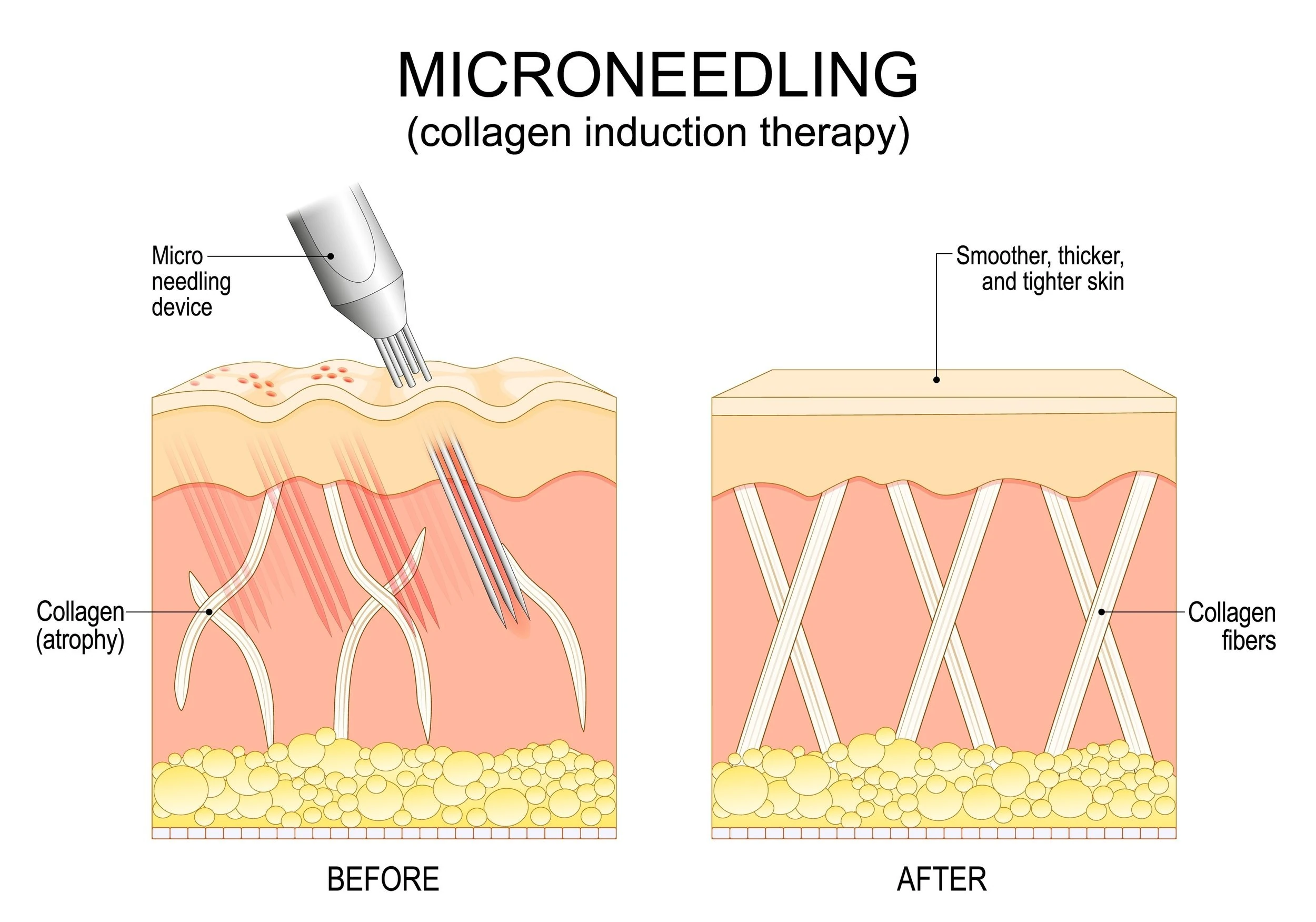 Diagrama del microneedling como inducción de colágeno, comparando la piel antes y después