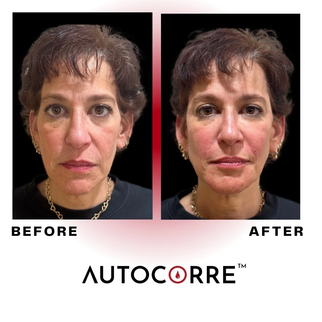 Autocorre before and after portrait, front view, with the Autocorre name under the photos