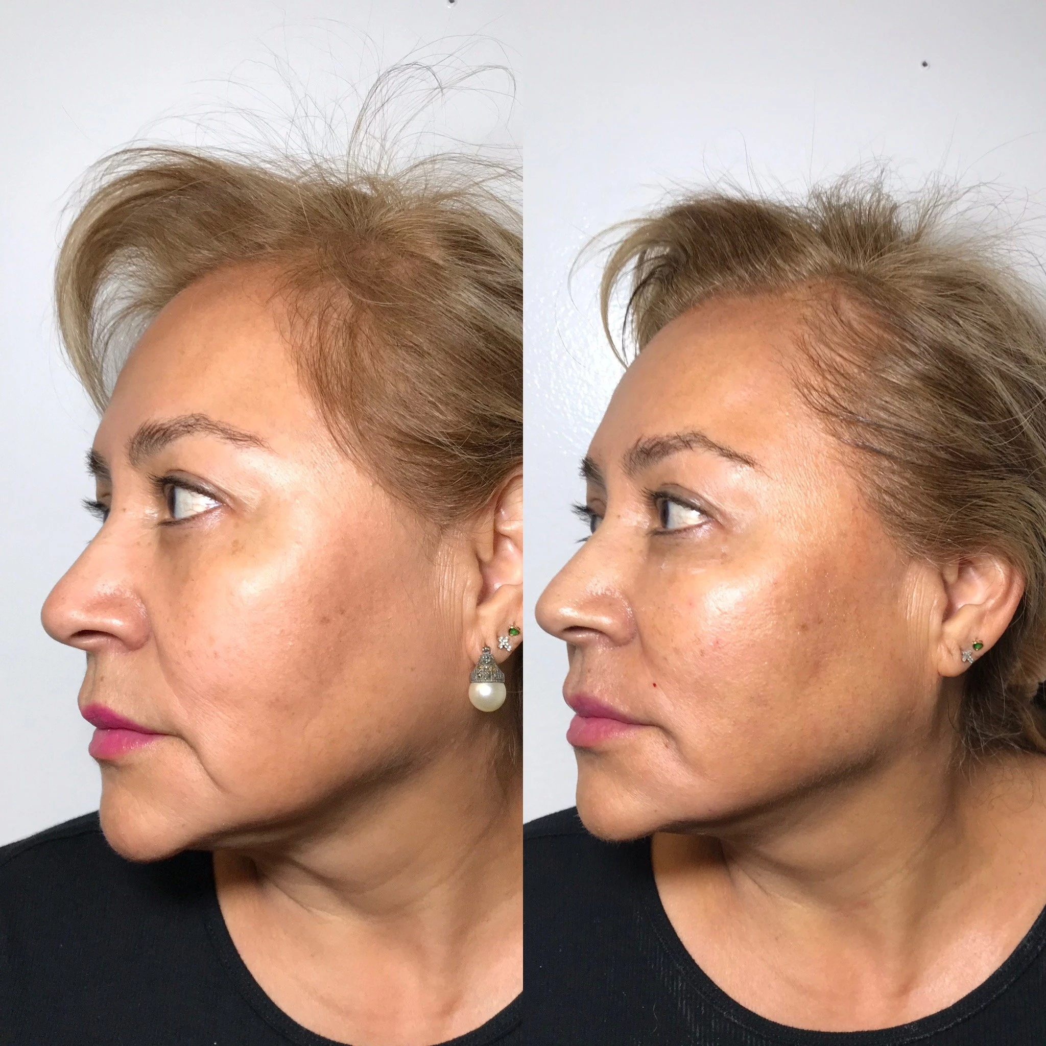 Autocorre before and after of a woman in three-quarter view